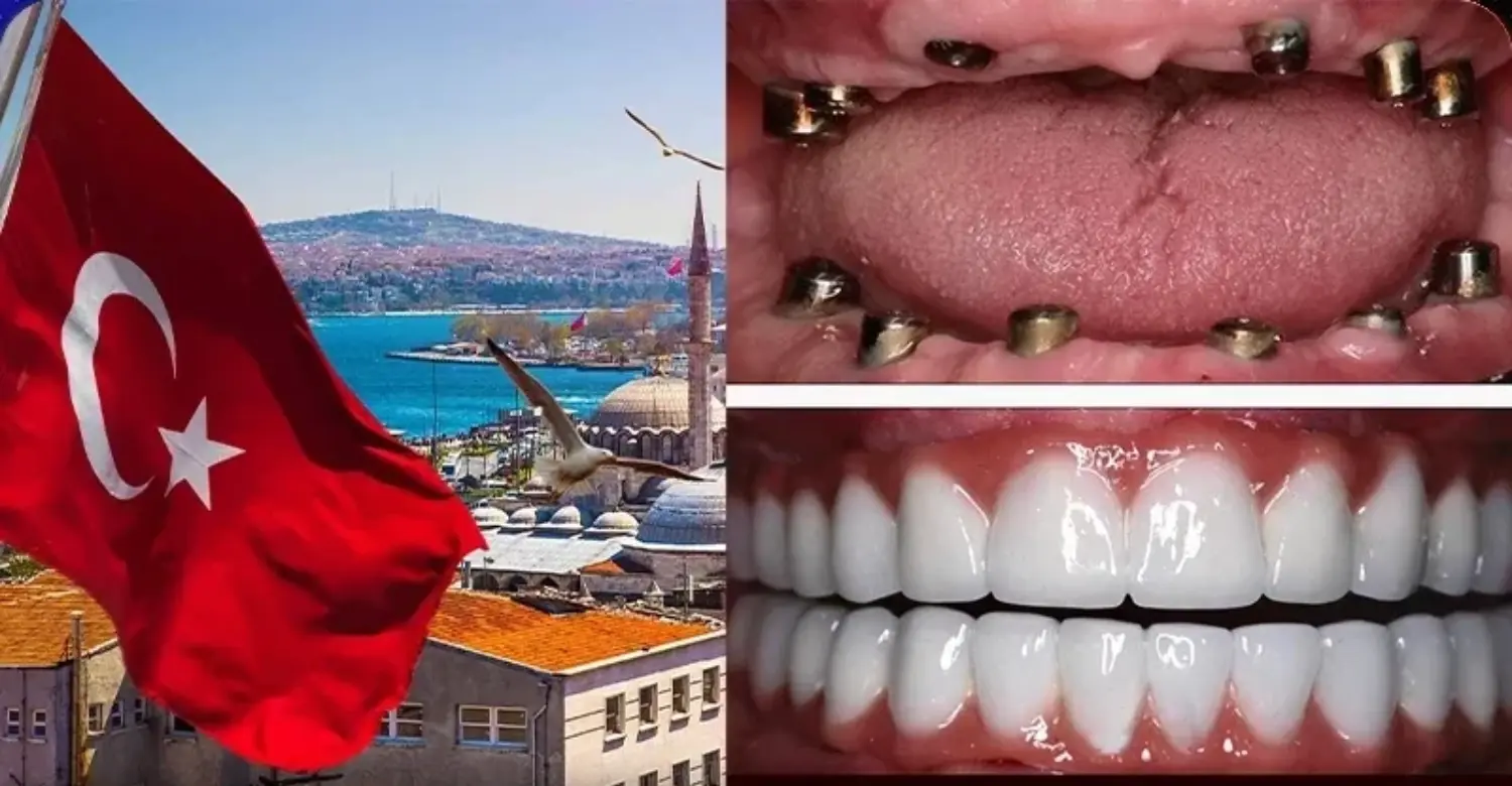 Same Day Dental Implants Turkey 2